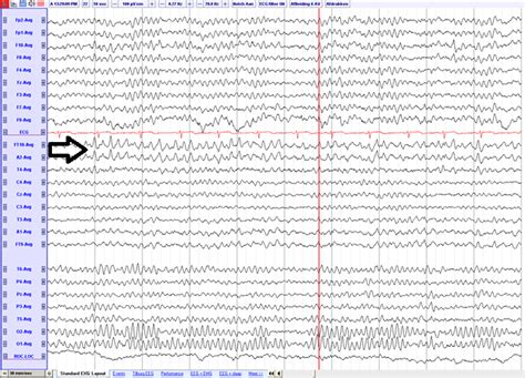 bets eeg|rmtd eeg.